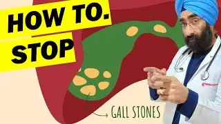 How to Stop GallBladder Stones बनने से कैसे रोकें | Dr.Education