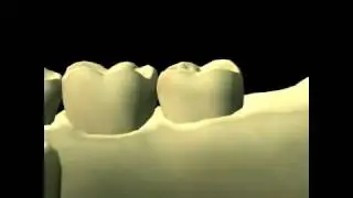MANDIBULAR TEETH - EMBRASURES
