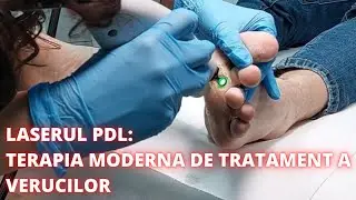 Eliminarea verucilor cu Laser Vascular PDL | DermaBeauty Clinique