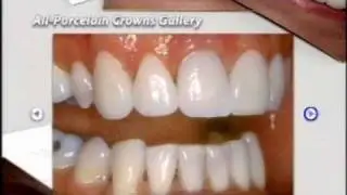 All Porcelain Crowns