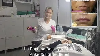 Hyaluron Volumenaufbau nadelfrei  mit dem Medical Pen von Yavu,nadelfrei, ohne Spritze
