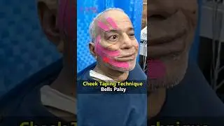 Bell&rsquo;s palsy || Facial palsy || K-Taping #physioterapy #physiotherapytreatment #neurorehabilitation