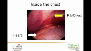 Pediatric Chest Deformities   Pectus   Webinar
