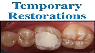 Temporary restorations