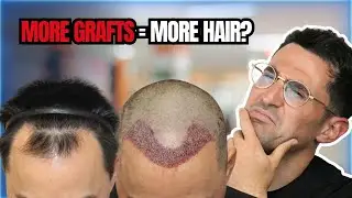 How Many Grafts Can You REALLY Take? The Truth About Donor Area Safety