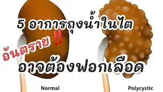 5 อาการถุงน้ำที่ไต อันตราย‼️อาจต้องฟอกเลือด|รู้ไว้จะได้ไม่ป่วย|โรคไต|ถุงน้ำที่ไต|ซีสต์ที่ไต