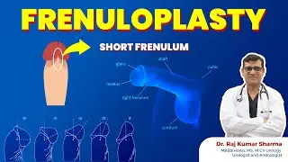 Tight Frenulum and Frenuloplasty by Dr Raj Kumar Sharma