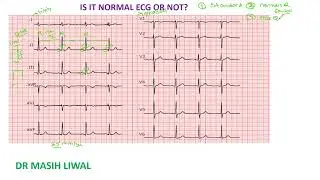 How to differentiate  normal ECG from abnormal ( part1)3.video