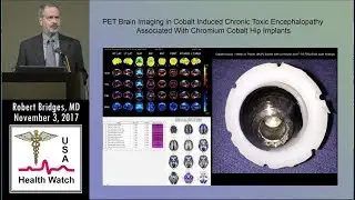 Brain Toxicity From Cobalt in Artificial Hip Implants As Seen on PET Scan
