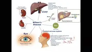 pediatric Hepatology (Wilson's Disease)