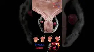 Prostate CAncer 🩺 3D Animation 📽 Medical Arts #shorts