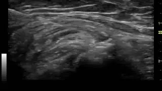 Hydrodissection for LFCN Syndrome and SCN Entrapment Following Revision Total Hip Arthroplasty