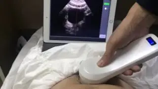 Wireless bladder scanner