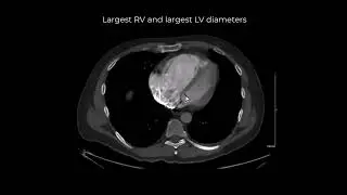 Right heart strain? RV/LV diameter ratio on CT PE studies
