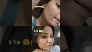 Best 3korean serums for acne prone sensitiveskin #acnecare #acneproneskin #clearskin  #ytshorts#yt