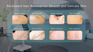 Diora-Q4 by Kosmyq: Advanced Multi-Wavelength Diode Laser Hair Removal Technology