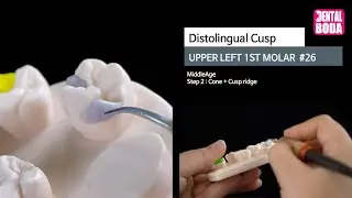 Upper Left 1st Molar  distolingual cusp 2 cone+cusp ridge (middle-aged) Wax-Up #26-4B