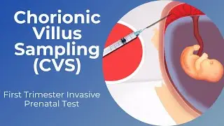 Chorionic Villus Sampling (CVS) | First Trimester Prenatal Diagnosis