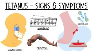 The Danger Of A Rusty Nail - Signs & Symptoms Of Tetanus