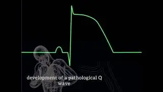 ECG changes during Myocardial infarction......