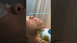 Лечение СПКЯ лазером волос на лице
