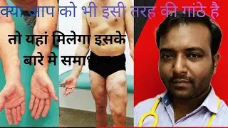 Lipoma complete guide and its homeopathic treatment