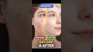 Acne Removal Before & After 😱 | How to remove acne | Skin Retouch EP-1 #ankitcreation #shorts