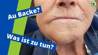 Dicke Backe, Schwellung, starke Schmerzen - Was ist zu tun? Abszess -  Patientenfall , Therapie