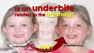 Is an underbite related to the breathing?