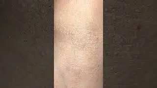 Lichen nitidus case 2 😱#shorts #doctorskin #shortsfeed #youtubeshorts