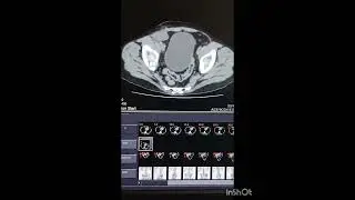 Renal Atrophy and Transplanted Kidney. 