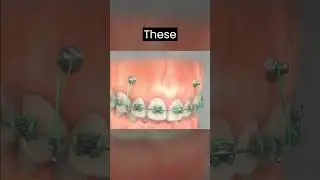 TADs 3 : The next level Orthodontic treatment technique