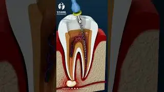 Sauvez votre dent atteinte de caries profondes gr&acirc;ce au traitement du canal radiculaire