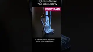 Foot pain due to high heels#physiotherapy #pain #exercise #gold
