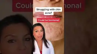 Need help getting rid of chin acne? || #shorts