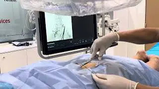 Transforaminal Epidural Injection (22/11/025)