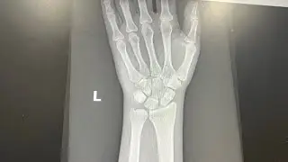 Vlog #7: I Injured My Wrist and I Am 10 Weeks out! 