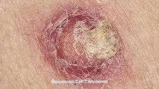 The Warning Signs of Skin Cancer &mdash; What Everyone Should Know