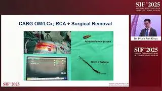 Room C- C2- Catastrophic Failure of Stent Balloon Deflation: A Rare PCI Complication