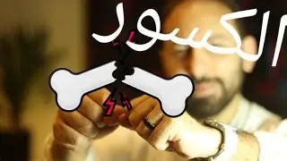كسور العضم - أنواع كسور العضم و أمتي الكسر يحتاج جراحه