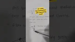 AC Joint Reconstruction with Hamstring Graft ..Dr Sai Chandra..Knee n Shoulder Surgeon