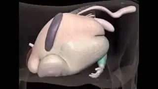 Desplazamiento de abomaso