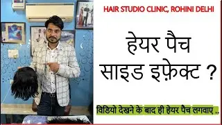 Side Effects of Hair Patch & Wig / हेयर पैच के साइड इफेक्ट