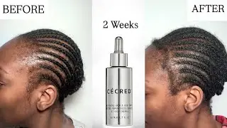 Cécred Restoring Hair & Edge Drops Review  Before & After 2 Weeks