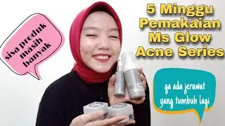 5 Minggu Pemakaian Ms Glow Acne Series | Alhamdulillah Membaik | Review Ms Glow Acne Series