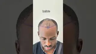 Afro Hair Transplant Before and After  | Afro Hair Transplant in Turkey #hairtransplant