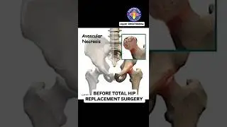 AVN ? AVASCULAR NECROSIS OF HIPS ? Is Total Hip Replacement [THR] Successful Operation ? 👌💯🙏 #avn