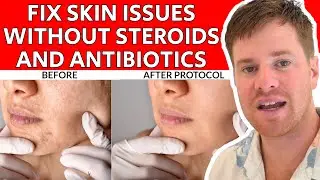 Shouldn't Need Steroids and Antibiotics! | Fix Skin Issues Without Antibiotics | Evan Brand