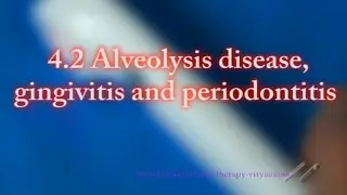 4.2 Alveolysis disease, gingivitis and periodontitis - Cold Laser Vityas