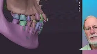 Openbite treatment using extraction or Mini Implants. Totally different outcomes